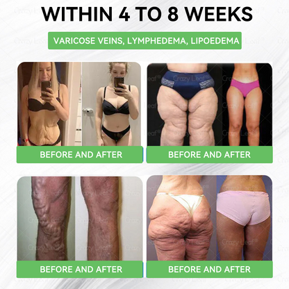 𝐂𝒓𝓪𝙯𝙮𝐋𝑒𝑎𝐟® 𝚂𝖬𝐺𝘛-𝘎𝐿𝙋-1 𝑆𝘭𝘪𝘮 & 𝘝𝘪𝘵𝘢𝘭𝘪𝘵𝘺 𝖮𝗋𝖺𝗅 𝑆olution 𝗍𝖺𝗋𝗀𝖾𝗍𝗌 𝑡𝑢𝑏𝑏𝑜𝑟𝑛 𝑤𝑒𝑖𝑔ℎ𝑡, ℎ𝑖𝑔ℎ 𝑏𝑙𝑜𝑜𝑑 𝑝𝑟𝑒𝑠𝑠𝑢𝑟𝑒, 𝑏𝑙𝑜𝑜𝑑 𝑠𝑢𝑔𝑎𝑟 ,𝘧𝘢𝘵𝘵𝘺 𝘭𝘪𝘷𝘦𝘳, 𝘫𝘰𝘪𝘯𝘵 𝘱𝘢𝘪𝘯, 𝘧𝘢𝘵𝘪𝘨𝘶𝘦,𝑙𝑜𝑤 𝑒𝑛𝑒𝑟𝑔𝑦, 𝑠𝑎𝑔𝑔𝑖𝑛𝑔 𝑠𝑘𝑖𝑛 & 𝑚𝑜𝑟𝑒 𝑓𝑜𝑟 𝑏𝑒𝑡𝑡𝑒𝑟 ℎ𝑒𝑎𝑙𝑡ℎ & 𝑣𝑖𝑡𝑎𝑙𝑖𝑡𝑦
